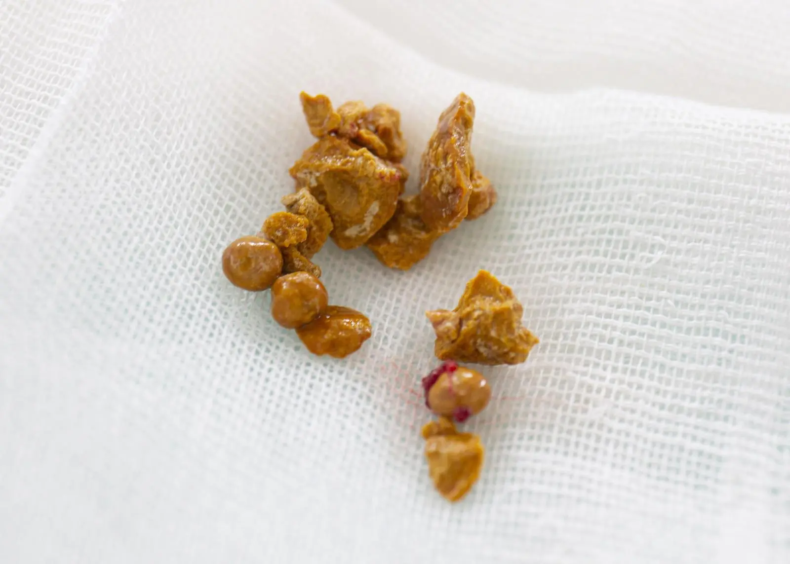 Stone fragments removed during an endoscopic procedure