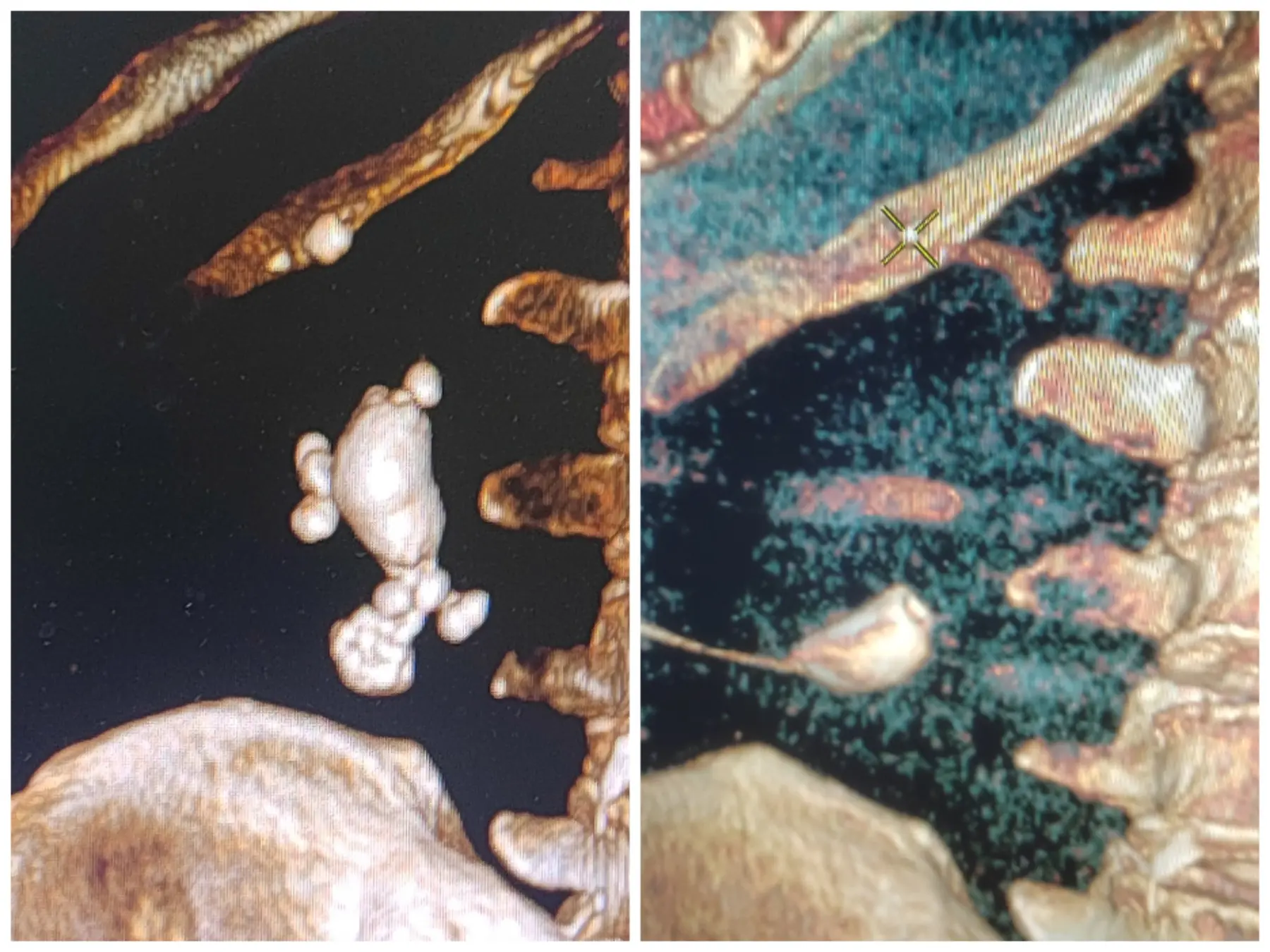 Comparison of CT before and after percutaneous kidney stone removal