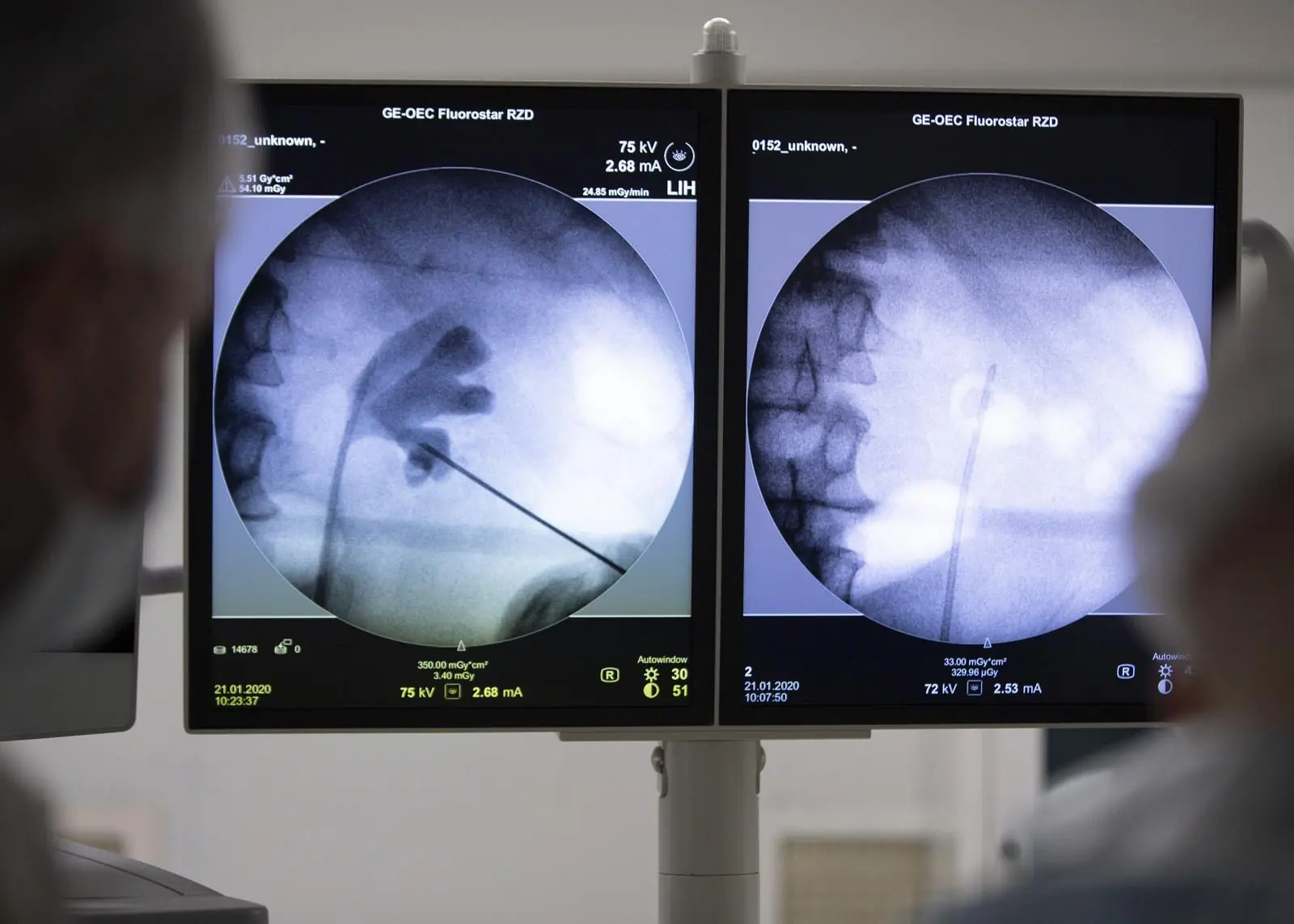 X-ray guidance of puncture into the renal collecting system