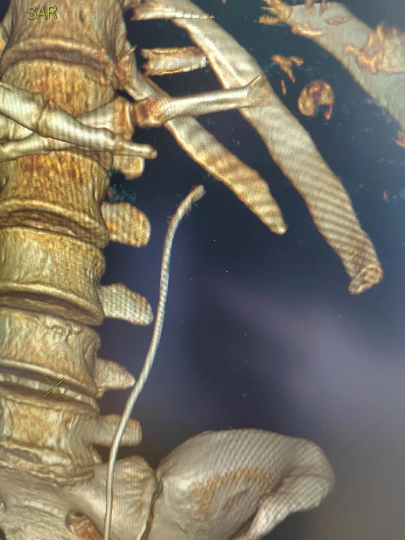 Follow-up 3D CT of the kidney after a percutaneous procedure
