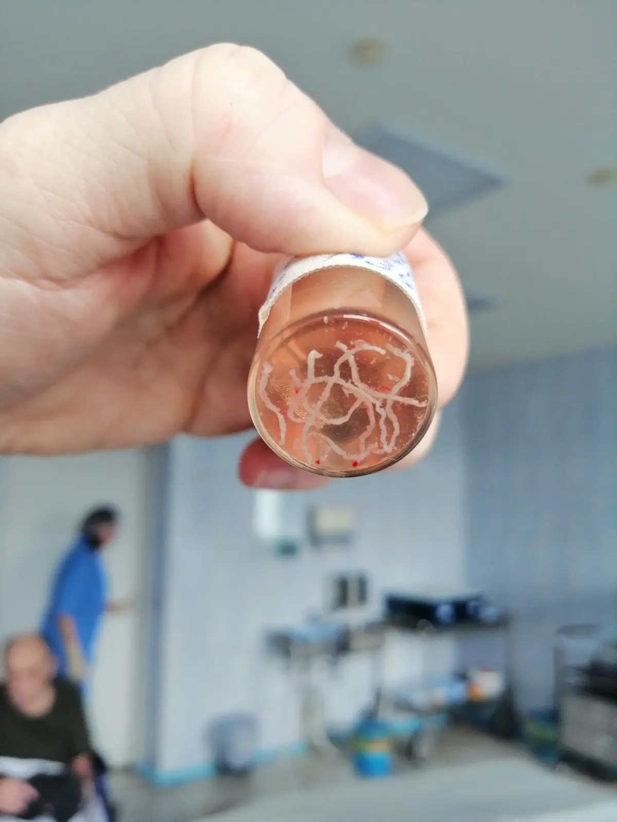 Prostate tissue cores after biopsy in a labelled container