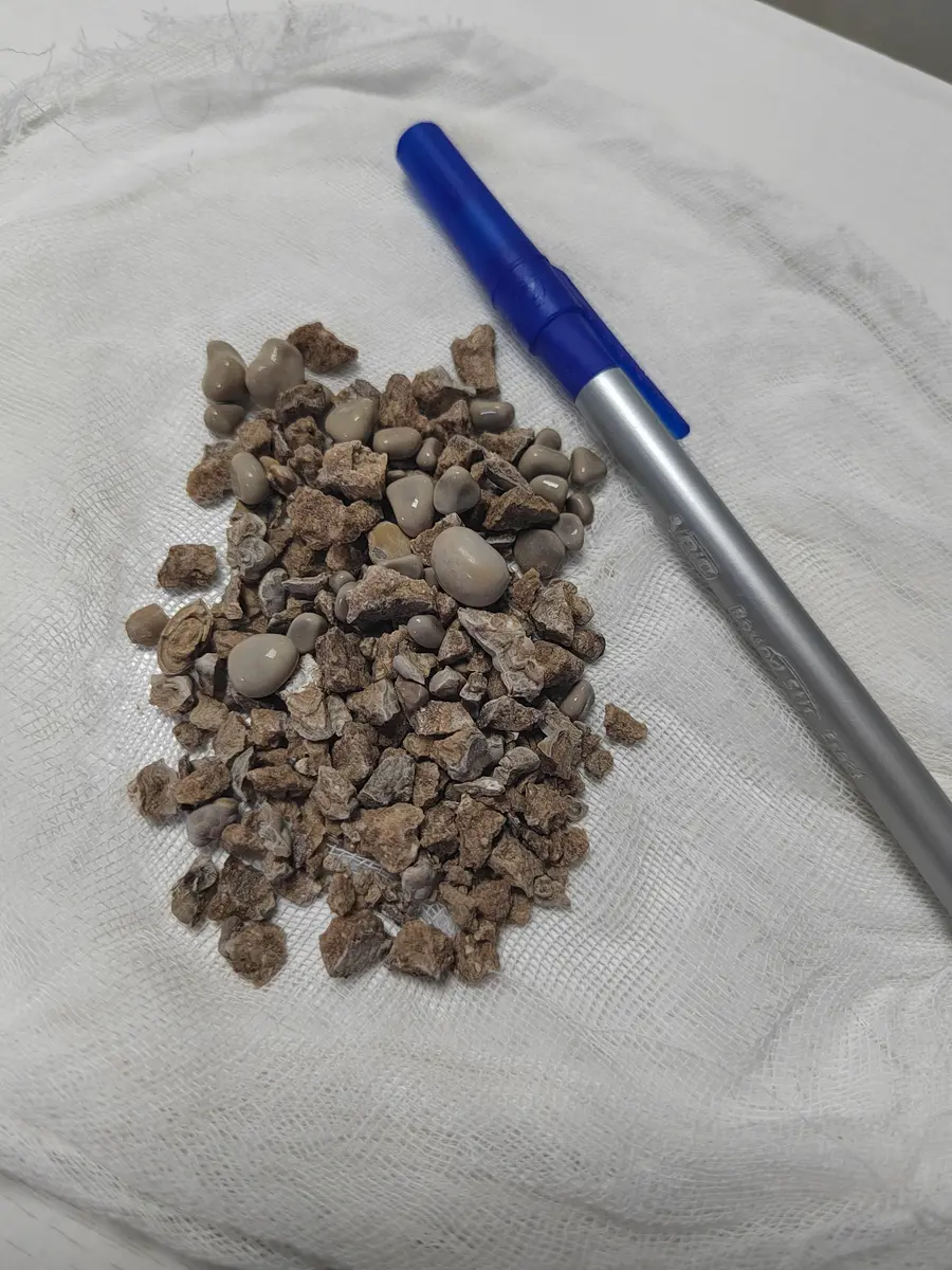 Extracted kidney stone fragments beside a medical marker